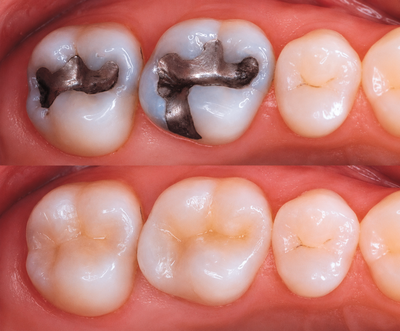 Aplicación de calzas o resinas dentales