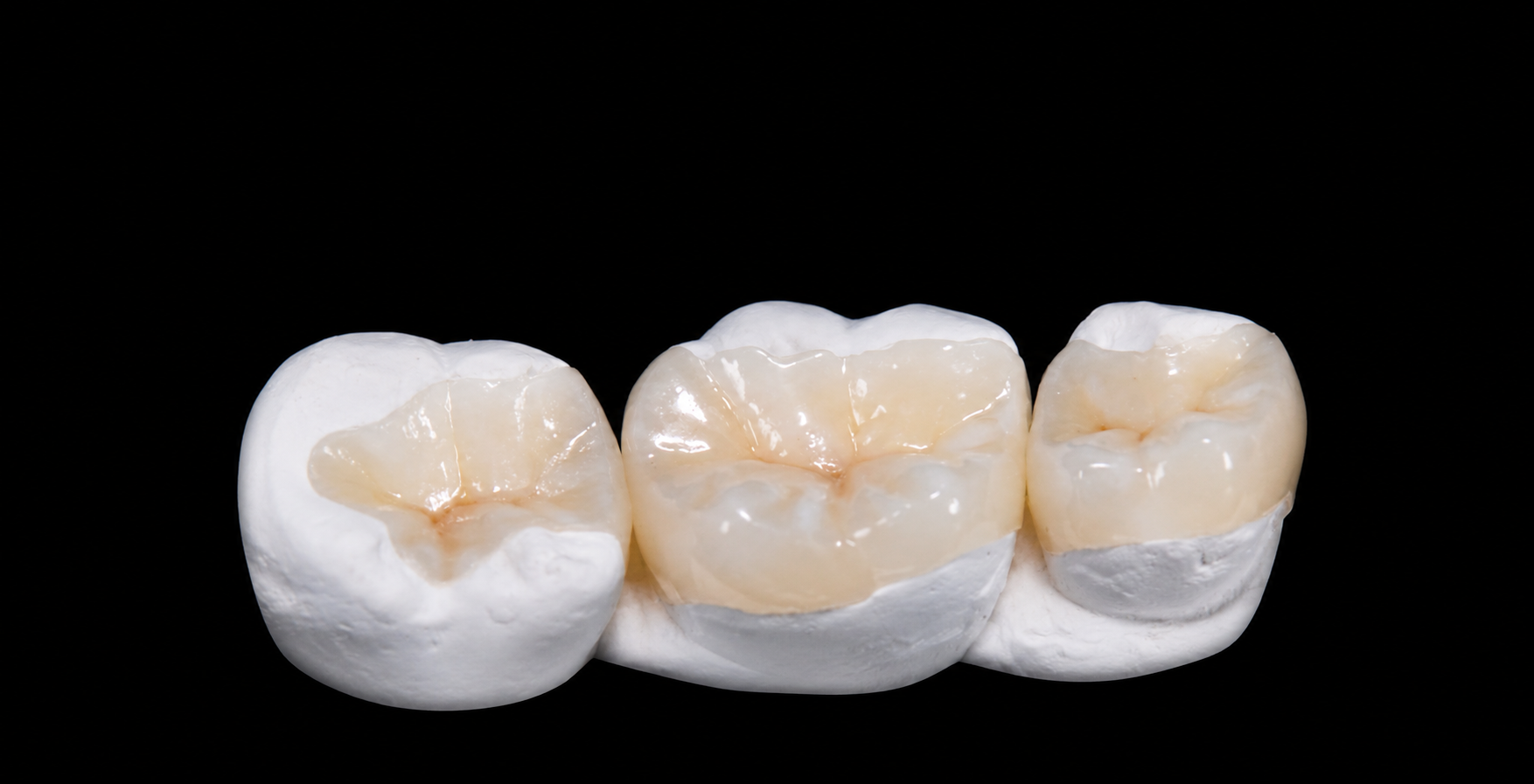 Incrustaciones Dentales en Molar